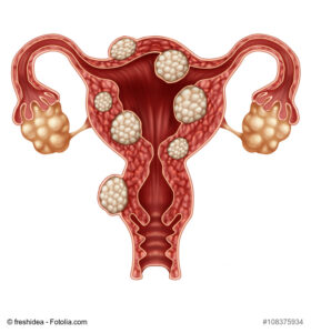 Myths about uterine fibroids