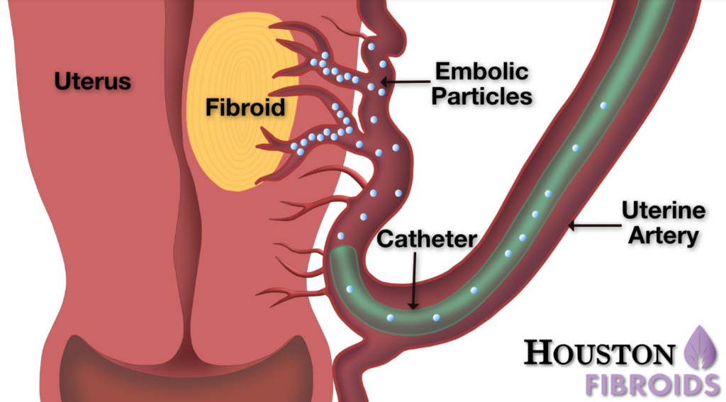 Uterine Fibroid Embolization In Houston TX | Houston Fibroids