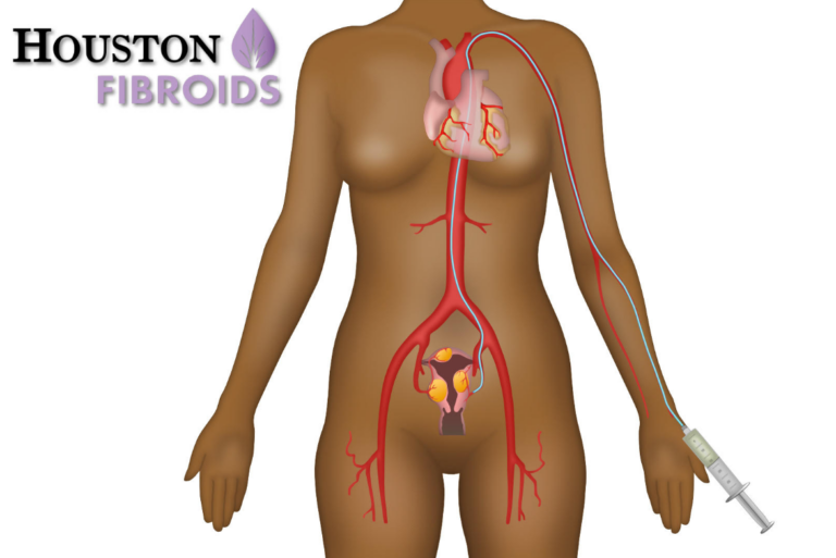 fibroids treatment