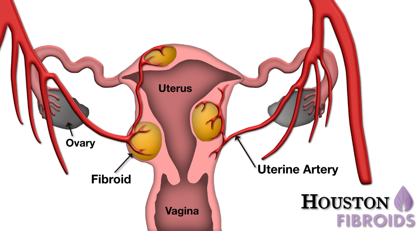 uterine fibroid graphic