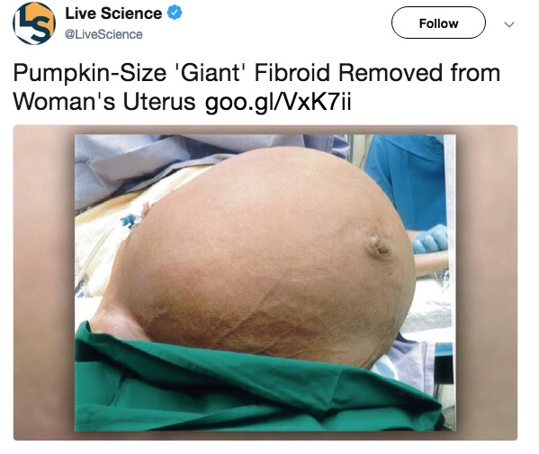 pumpkin-sized fibroid
